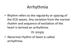 Bradycardia