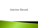 Uterine fibroid