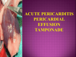 ACUTE PERICARDITIS