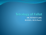 Tetralogy of Fallot