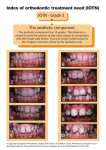 Index of orthodontic treatment need (IOTN) IOTN