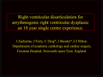 Right Ventricular disarticulation for arrythmogenic right ventricular