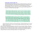 Ventricular_Tachycardia