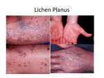 Lichen Planus