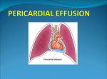 ADEM- Acute Disseminated EncephaloMyelitis in children