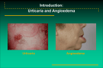 Urticaria and Angioedema - Hatzalah of Miami-Dade