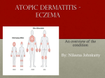 Atopic dermatitis - ECZEMA