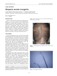 Alopecia areata incognita