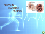 NOUVEAUTES en STIMULATION CARDIAQUE