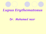 Systemic Lupus Erythematosus