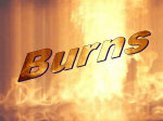 Burns